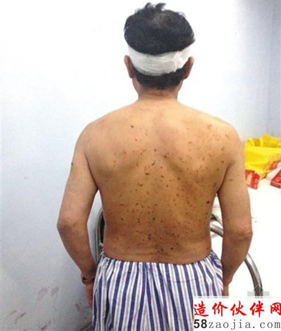 一名矿工因爆炸冲击波摔倒在巷道侧壁上,背部多处受伤,头部缝了七针