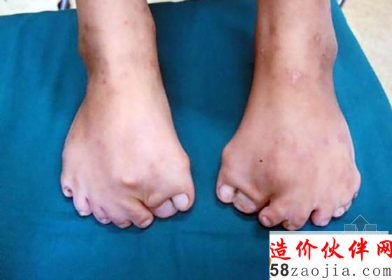 8岁女孩长15根脚趾_副本.jpg